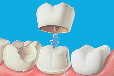 Протезирование (ортопедическая стоматология)